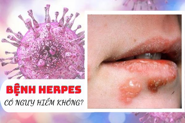 Bệnh Herpes sinh dục là gì? Có nguy hiểm không?