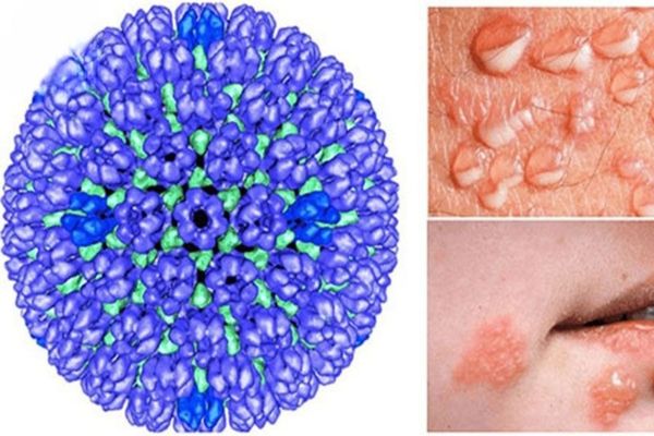 Bệnh mụn rộp sinh dục do virus HSV gây ra