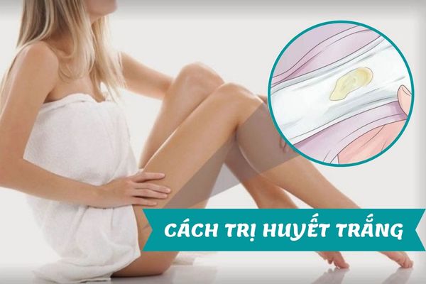 Bật mí cách trị huyết trắng hiệu quả – Ngăn chặn bệnh phụ khoa ở nữ giới