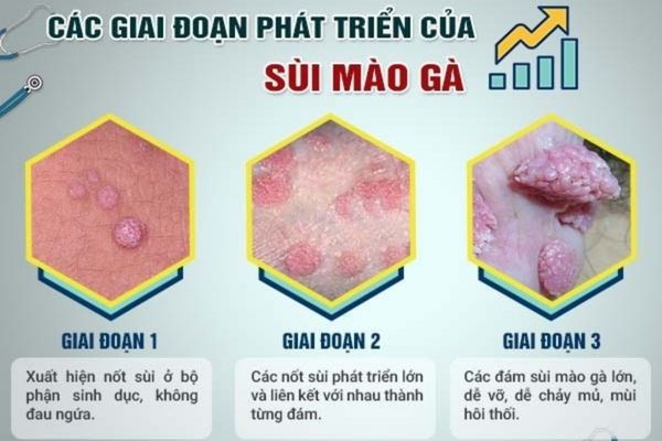 Các giai đoạn phát triển của bệnh sùi mào gà