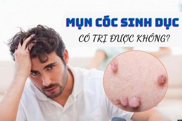 Mụn cóc sinh dục là bệnh gì? Có chữa trị được không?