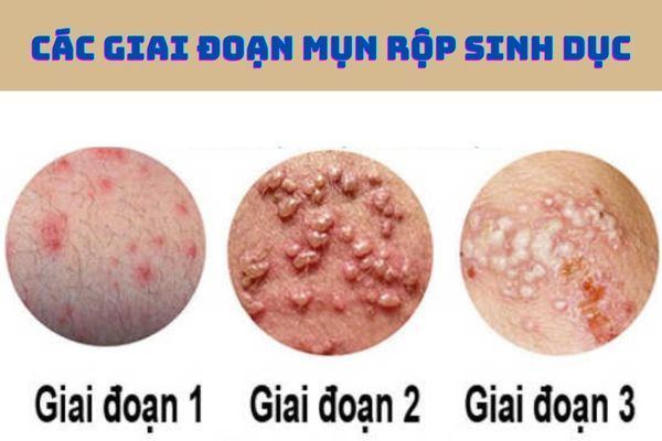 Mụn rộp sinh dục trải qua nhiều giai đoạn phát triển