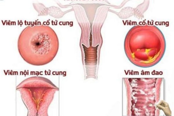 Chi phí điều trị mụn rộp sinh dục bao nhiêu tiền?