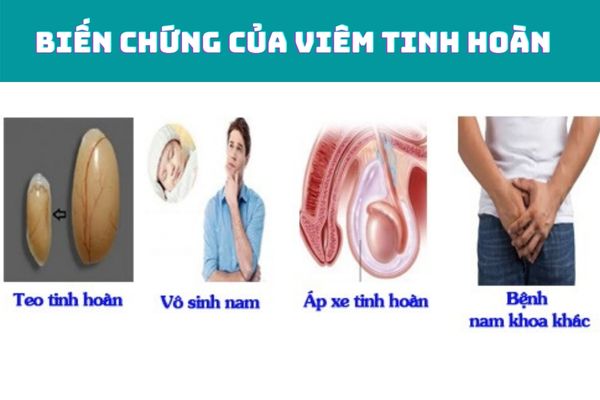 Các biến chứng nguy hiểm của viêm mào tinh hoàn gây ra