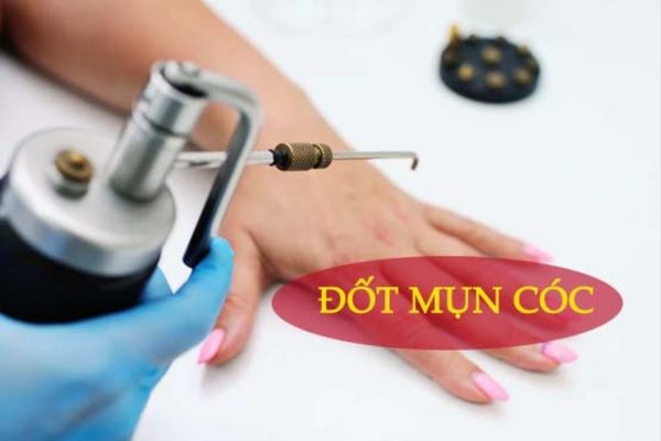 Phương pháp đốt mụn cóc hiệu quả, an toàn, không lo tái phát