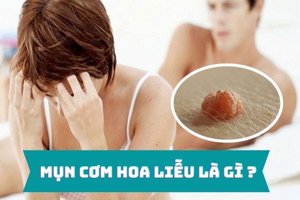 Mụn cơm hoa liễu là gì – Nguyên nhân và cách điều trị hiệu quả