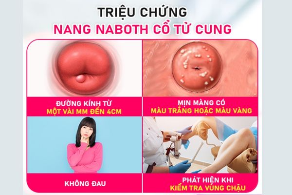 Triệu chứng nhận biết bệnh nang naboth tử cung ở nữ giới