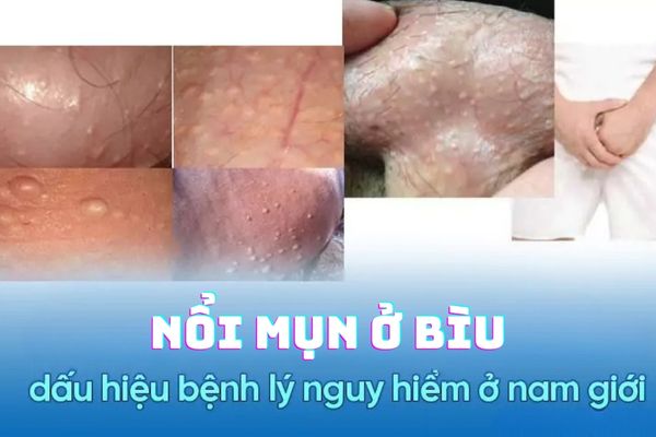 Cảnh báo bệnh nguy hiểm gây nổi mụn ở bìu