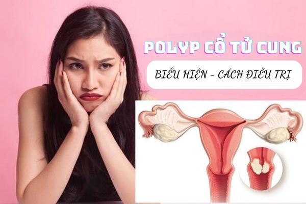 Polyp cổ tử cung – Dấu hiệu nhận biết và cách điều trị