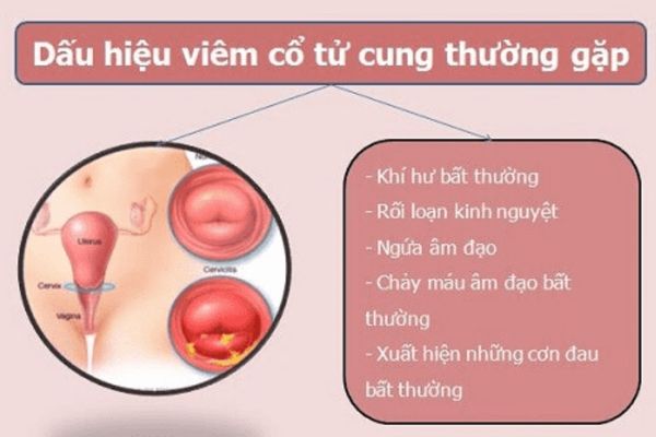 Dấu hiệu nhận biết bệnh viêm lộ tuyến cổ tử cung