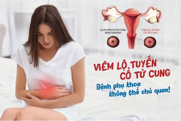 Những điều cần biết về bệnh viêm lộ tuyến cổ tử cung