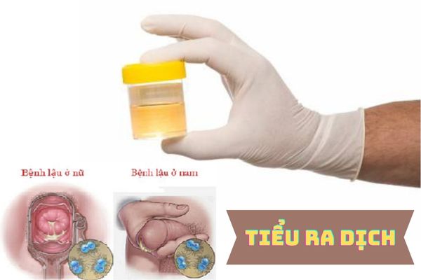 Tiểu ra dịch – Dấu hiệu cảnh báo bệnh lậu không nên bỏ qua