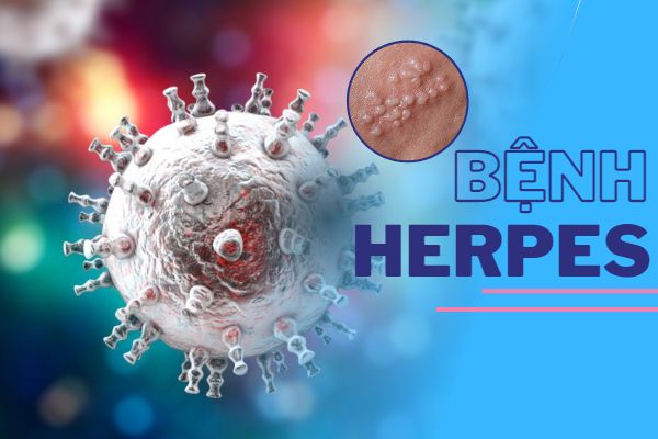 Bệnh Herpes là gì và làm cách nào khắc phục?