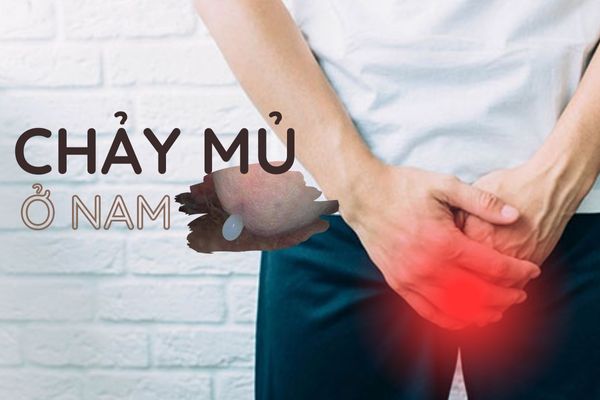 Chảy mủ ở nam 90% cảnh báo bệnh lậu