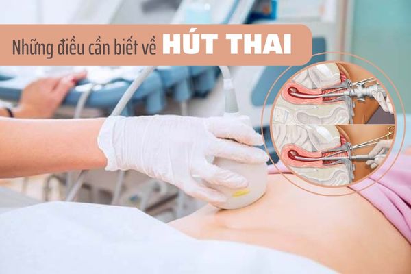 Phương pháp hút thai là gì? Những điều cần lưu ý