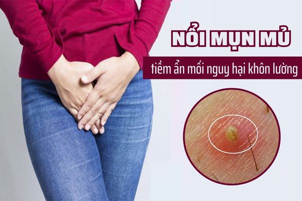 Mối nguy tiềm ẩn đằng sau triệu chứng nổi mụn mủ