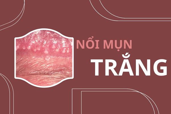 Tại sao vùng kín nổi mụn trắng bất thường?