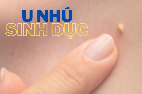 U nhú sinh dục là hiện tượng gì?