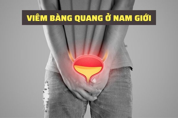 Những thông tin nam giới cần biết về viêm bàng quang 