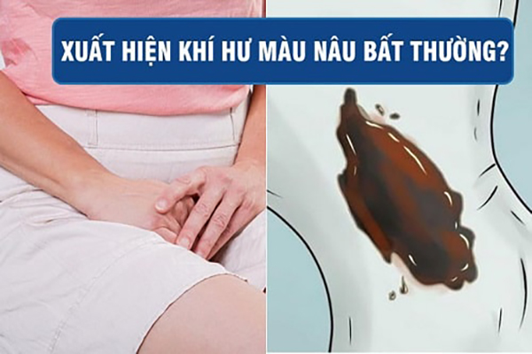 Khí hư màu nâu – Cảnh báo nhiều bệnh lý phụ khoa nguy hiểm