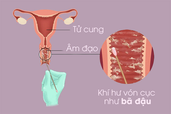 Khí hư vón cục cảnh báo nhiều bệnh lý nguy hiểm