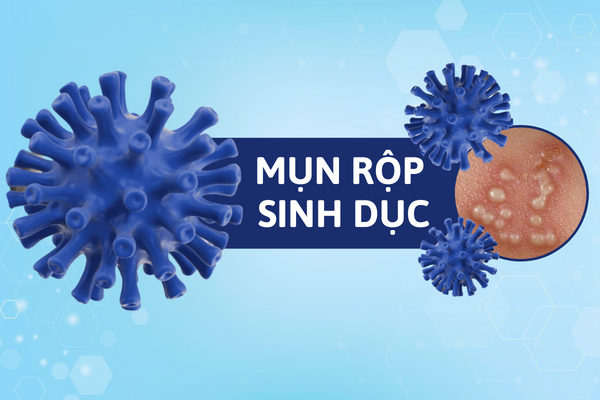 Mụn rộp sinh dục – Bạn có thực sự hiểu rõ?