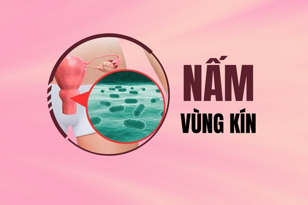 Sự thật về bệnh nấm vùng kín