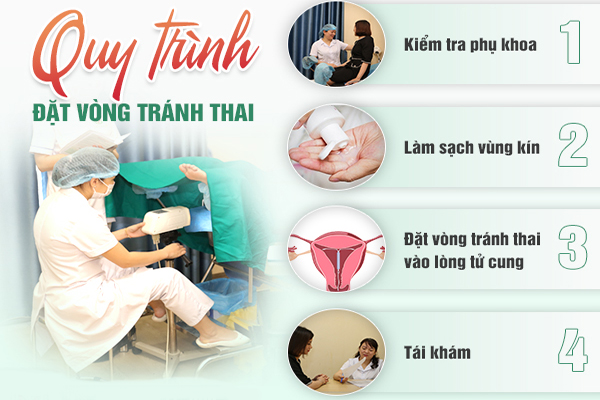 Quy trình đặt vòng tránh thai đúng chuẩn khoa học tại Trường Hải