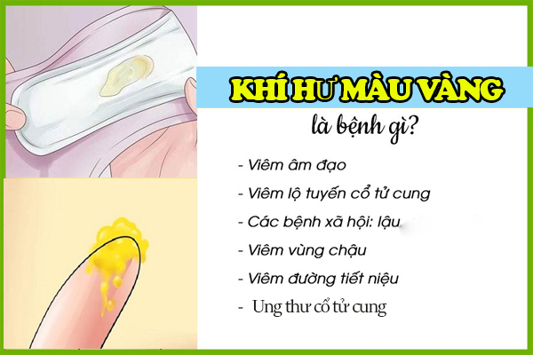 Khí hư màu vàng biểu hiện đáng lo ngại cần khám sớm