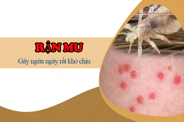 Rận mu – Những thông tin quan trọng bạn cần biết