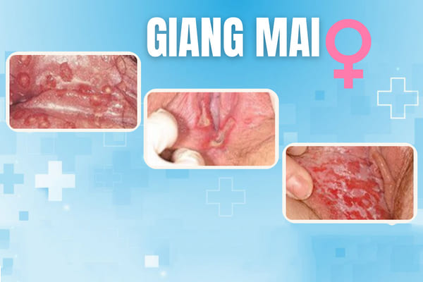 Hinh-anh-giang-mai-giai-doan-dau-2