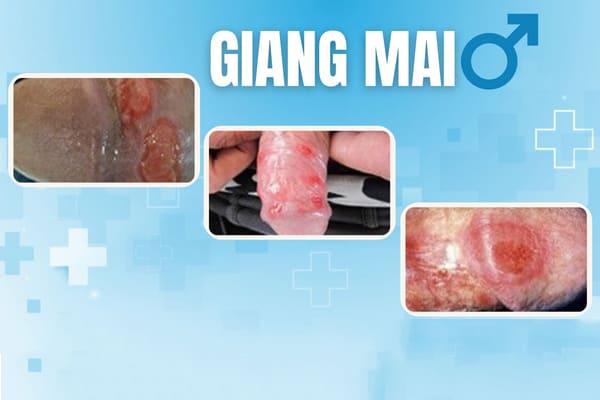 Hinh-anh-giang-mai-giai-doan-dau-3