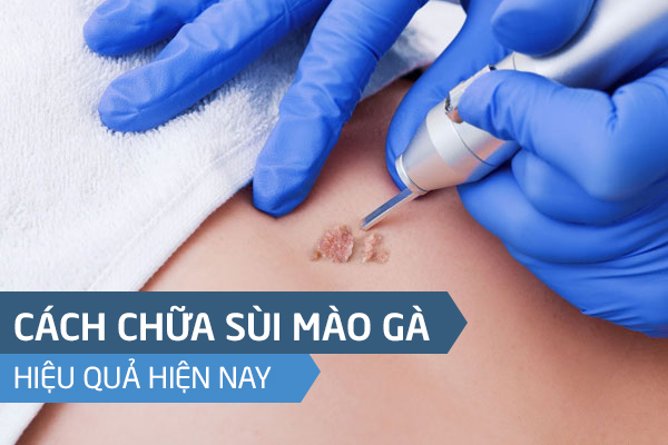 Chữa Sùi Mào Gà Hiệu Quả Chỉ Sau Một Lần Không Lo Tái Phát