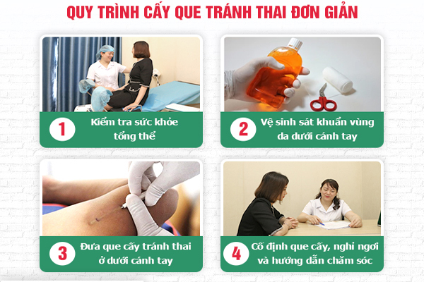 Quy trình cấy que chuẩn khoa học tại Phòng Khám Đa Khoa Trường Hải