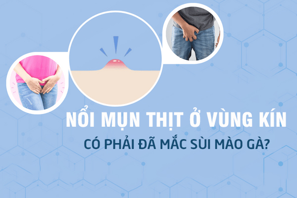 Nổi Mụn Thịt Ở Vùng Kín Nam, Nữ Có Phải Đã Mắc Sùi Mào Gà?