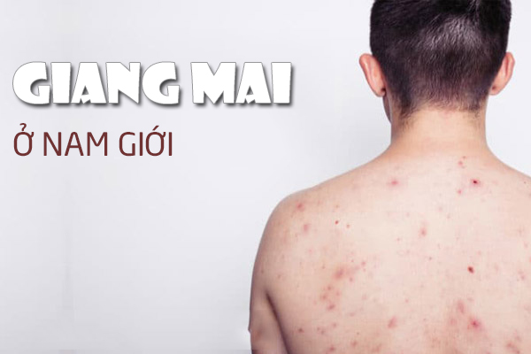 Giang mai nam: Hình ảnh, biểu hiện và cách chữa trị hiệu quả 