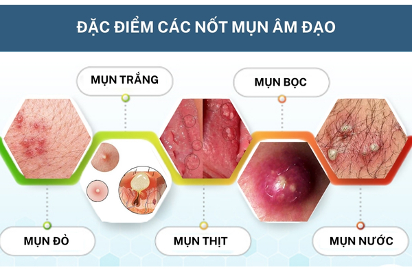 Nổi mụn âm đạo là bị bệnh gì?